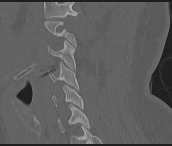 Cervical disc replacement (Radiopaedia 44025-47541 Sagittal bone window 29).png
