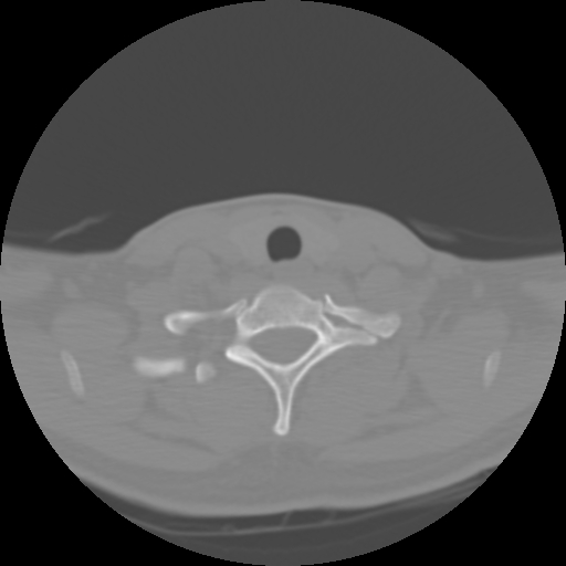 Cervical rib (Radiopaedia 71110-81363 Axial non-contrast 44).jpg