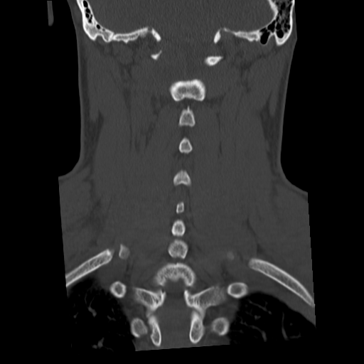 Cervical schwannoma (Radiopaedia 57979-64974 Coronal bone window 40).png