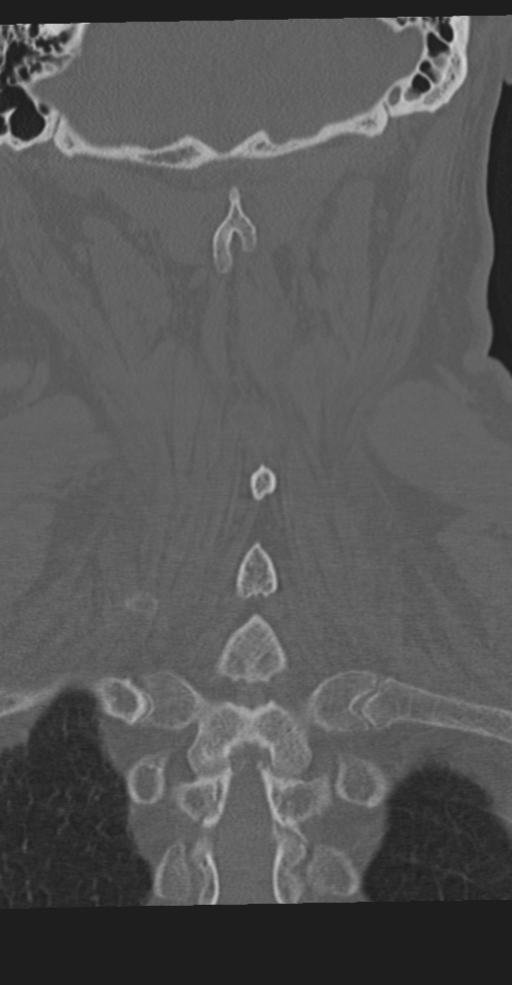 Cervical spine fracture in the setting of ankylosis (Radiopaedia 37038-38715 Coronal bone window 54).png