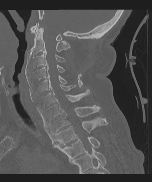 Cervical spine fracture in the setting of ankylosis (Radiopaedia 37038-38715 Sagittal bone window 39).png