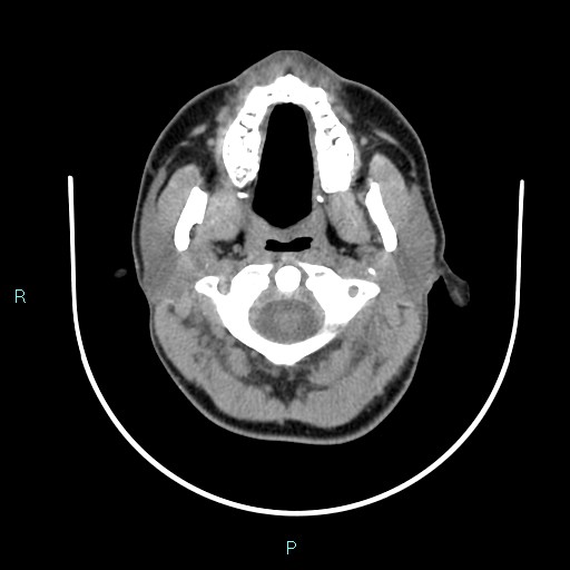 Cervical thymic cyst (Radiopaedia 88632-105335 Axial non-contrast 94).jpg