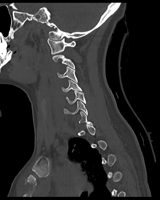 Cervical tuberculous spondylitis (Radiopaedia 39149-41365 Sagittal bone window 48).png