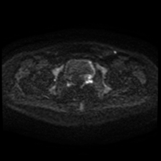 Cesarian section scar endometriosis (Radiopaedia 66520-75799 Axial DWI 95).jpg