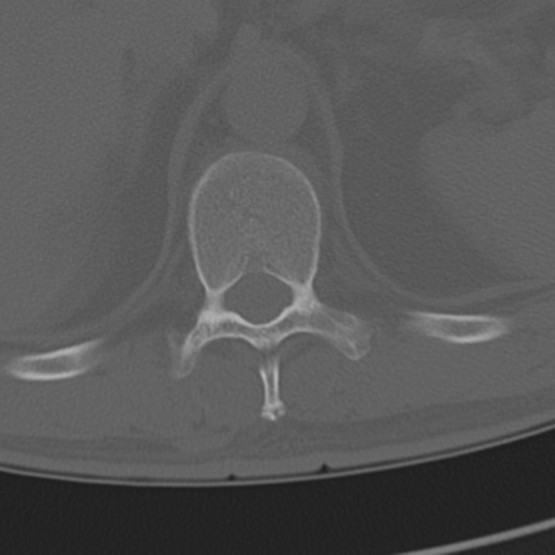 Chance fracture (Radiopaedia 33854-35020 Axial bone window 79).png