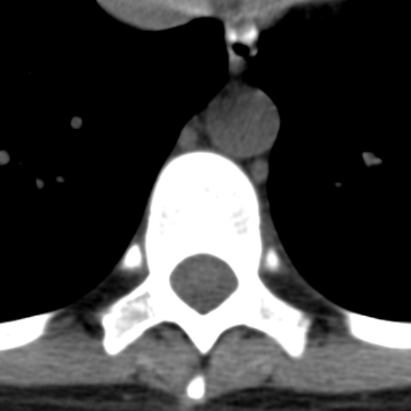 Chance fracture (Radiopaedia 36521-38081 Axial non-contrast 28).jpg