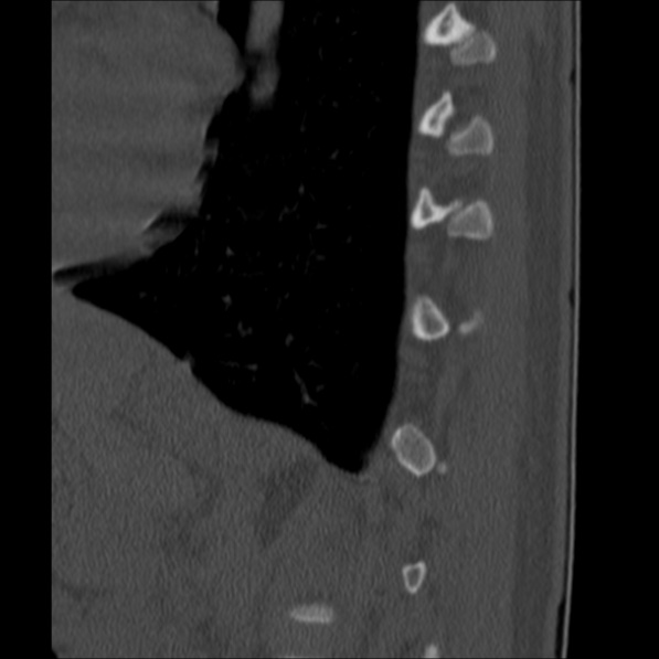 Chance fracture (Radiopaedia 36521-38081 Sagittal bone window 61).jpg