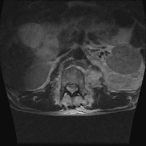 File:Chance type fracture (Radiopaedia 31020-31725 Axial T2 9).jpg