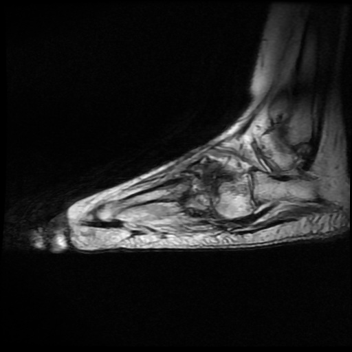 File:Charcot arthropathy (Radiopaedia 55056-61422 Sagittal T2 14).jpg