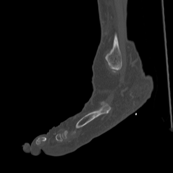 Charcot joint (Radiopaedia 36629-38194 Sagittal bone window 26).jpg