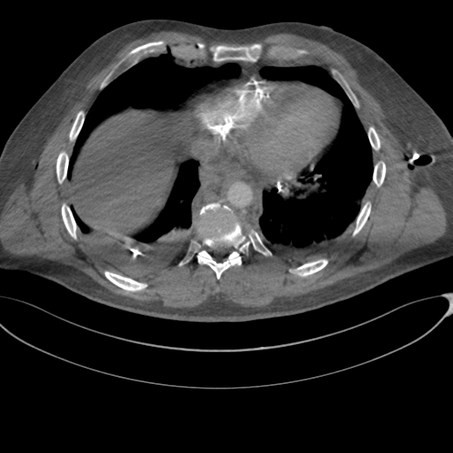 File:Chest multitrauma - aortic injury (Radiopaedia 34708-36147 A 210).png