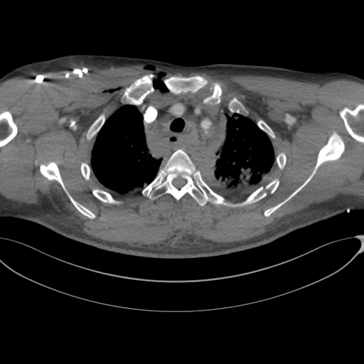 File:Chest multitrauma - aortic injury (Radiopaedia 34708-36147 A 63).png