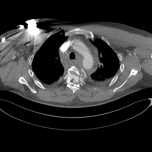 File:Chest multitrauma - aortic injury (Radiopaedia 34708-36147 A 91).png