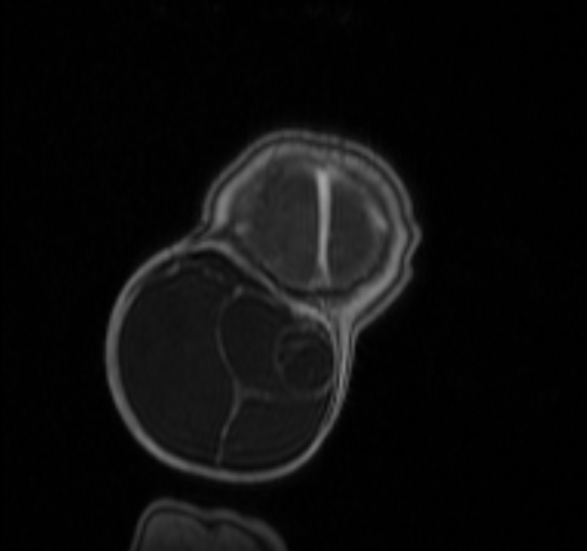 Chiari III malformation with occipital encephalocele (Radiopaedia 79446-92559 Coronal T1 C+ mpr 50).jpg