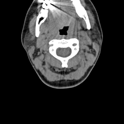 Chiari I malformation and obstructive hydrocephalus (Radiopaedia 41185-43981 D 40).png