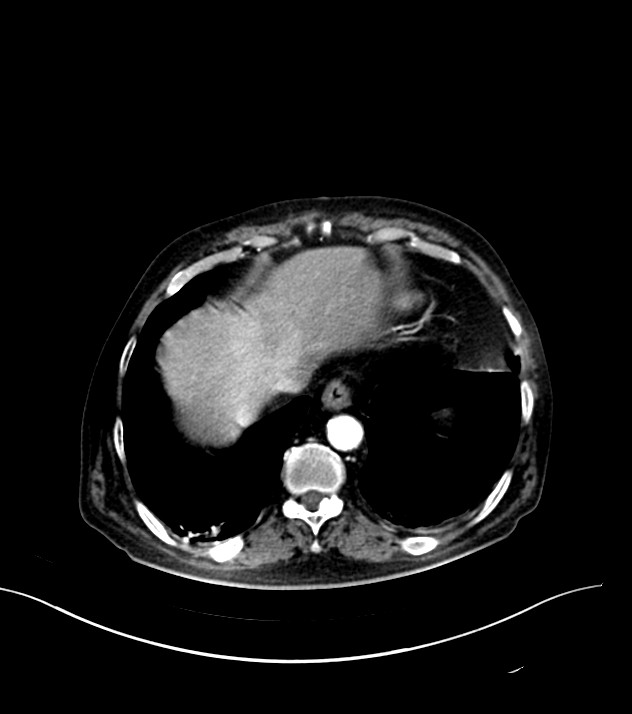 Cholangiocarcinoma with cerebral metastases (Radiopaedia 83519-98629 B 8).jpg