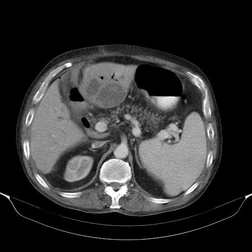 File:Cholangitis and abscess formation in a patient with cholangiocarcinoma (Radiopaedia 21194-21100 A 17).jpg