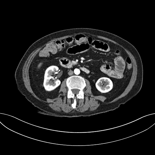 Cholecystoduodenal fistula due to calculous cholecystitis with gallstone migration (Radiopaedia 86875-103077 A 35).jpg