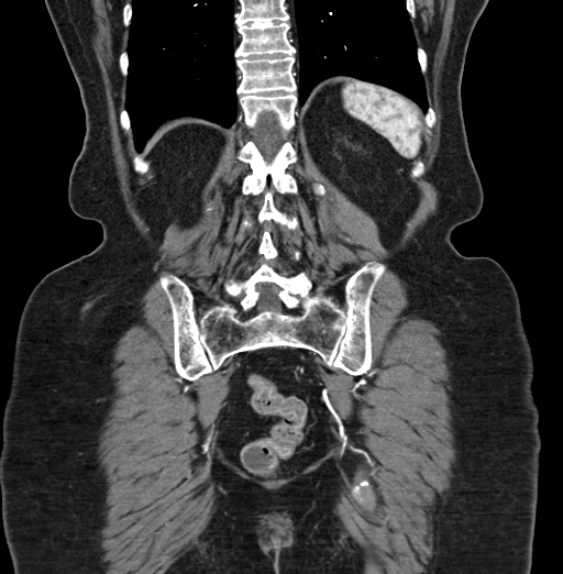 File:Cholecystoduodenal fistula due to calculous cholecystitis with gallstone migration (Radiopaedia 86875-103077 B 37).jpg
