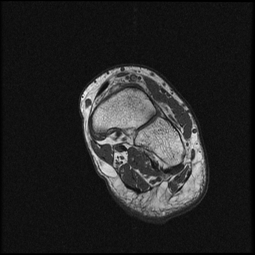 File:Chondroblastoma - midfoot (Radiopaedia 64831-73765 Short axis T1 10).jpg