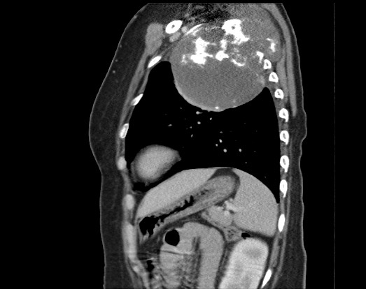 Chondrosarcoma - chest wall (Radiopaedia 65192-74199 B 17).jpg