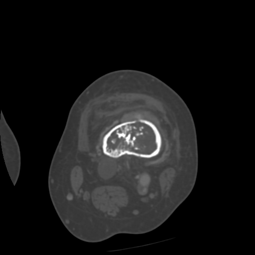 Chondrosarcoma - femur (Radiopaedia 64187-72954 Axial bone window 25).jpg