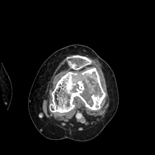 File:Chondrosarcoma - femur (Radiopaedia 64187-72954 Axial with contrast 46).jpg