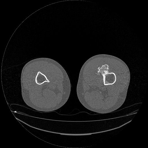 File:Chondrosarcoma arising from exostosis (Radiopaedia 59996-67507 Axial bone window 20).jpg