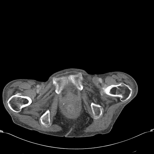 Chondrosarcoma of the spine (Radiopaedia 49871-55143 A 65).jpg