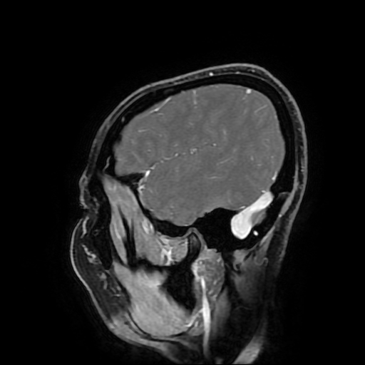 Chordoid glioma of third ventricle (Radiopaedia 91612-109340 F 47).jpg