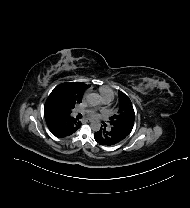 Chromophobe renal cell carcinoma (Radiopaedia 84239-99519 Axial non-contrast 3).jpg
