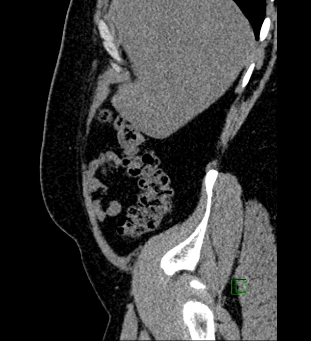 Chromophobe renal cell carcinoma (Radiopaedia 84286-99573 C 158).jpg