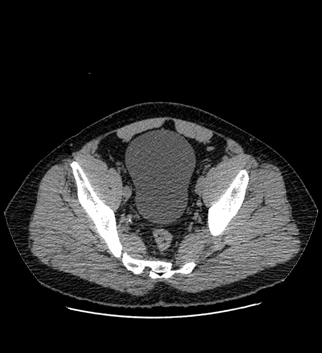 Chromophobe renal cell carcinoma (Radiopaedia 84337-99693 Axial non-contrast 135).jpg