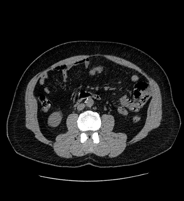 Chromophobe renal cell carcinoma (Radiopaedia 84337-99693 Axial non-contrast 73).jpg