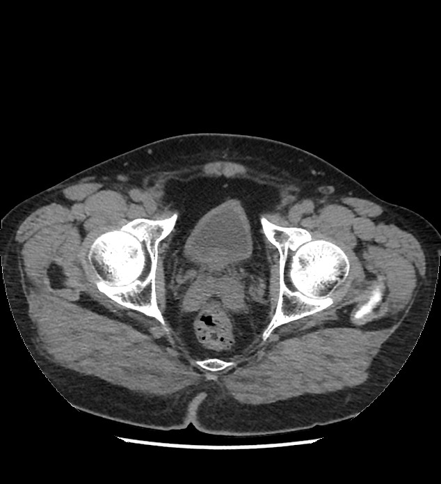 Chromophobe renal cell carcinoma (Radiopaedia 86879-103083 Axial non-contrast 124).jpg