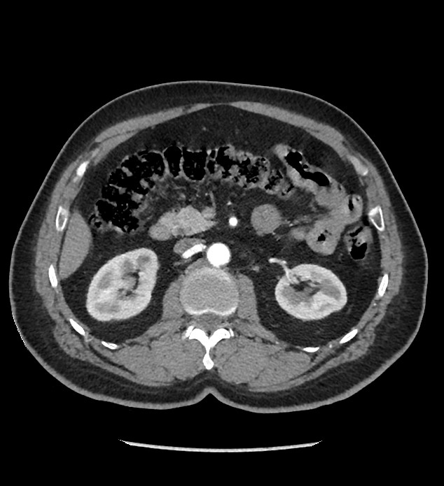 Chromophobe renal cell carcinoma (Radiopaedia 86879-103083 B 58).jpg