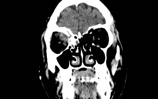 Chronic invasive fungal sinusitis (Radiopaedia 91563-109286 D 22).jpg