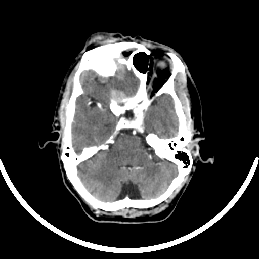 Chronic invasive fungal sinusitis with intraorbital and intracranial extension (Radiopaedia 56387-63046 B 116).jpg