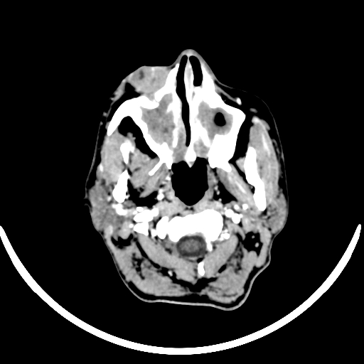 Chronic invasive fungal sinusitis with intraorbital and intracranial extension (Radiopaedia 56387-63046 B 28).jpg