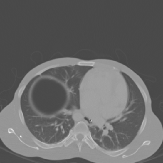 File:Chronic large bowel pseudo-obstruction (Radiopaedia 43181-46492 Axial bone window 17).jpg