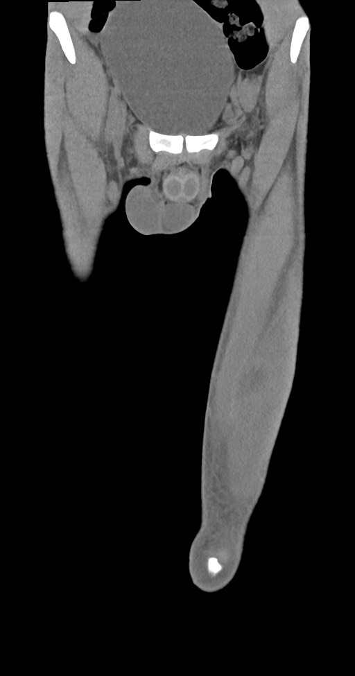Chronic osteomyelitis (with sequestrum) (Radiopaedia 74813-85822 E 8).jpg
