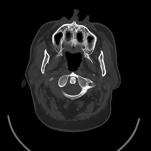 Chronic osteomyelitis - calvarial (severe) (Radiopaedia 69668-79616 Axial bone window 20).jpg