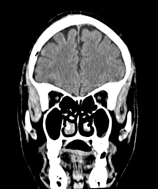 Chronic osteomyelitis - calvarial (severe) (Radiopaedia 69668-79616 Coronal non-contrast 21).jpg