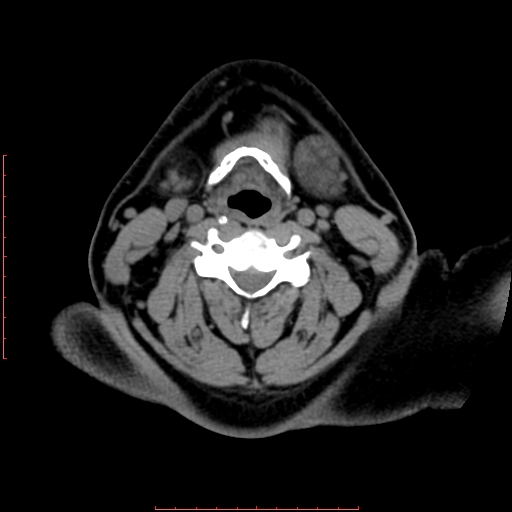File:Chronic submandibular sialolithiasis (Radiopaedia 69817-79814 Axial non-contrast 145).jpg