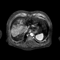 Cirrhosis and hepatocellular carcinoma in the setting of hemochromatosis (Radiopaedia 75394-86594 Axial T1 C+ fat sat 235).jpg