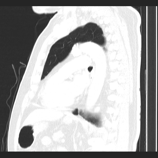 File:Classic complicated silicosis (Radiopaedia 49720-54961 Sagittal lung window 26).jpg