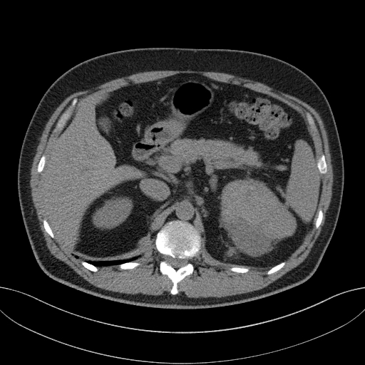 File:Clear cell renal cell carcinoma (Radiopaedia 61449-69393 Axial non-contrast 19).jpg