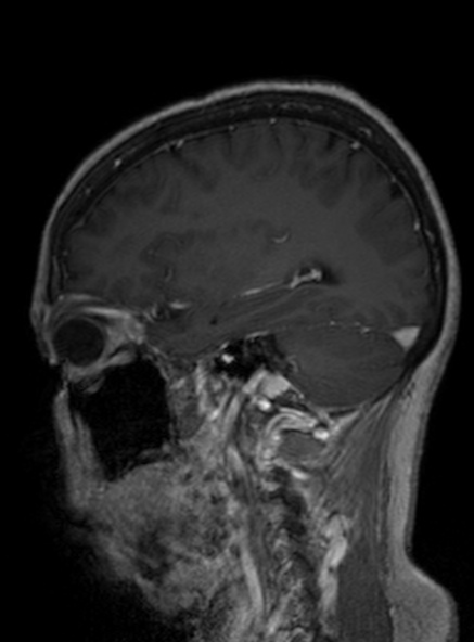 Clival meningioma (Radiopaedia 53278-59248 Sagittal T1 C+ 202).jpg