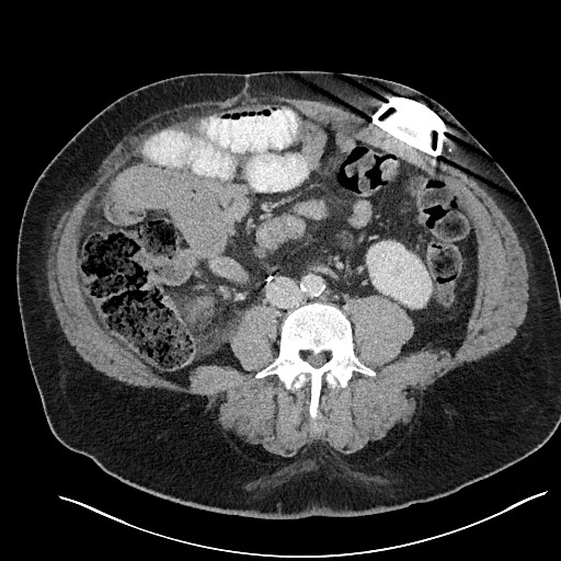 File:Closed loop obstruction - internal hernia into nephrectomy bed (Radiopaedia 59867-67320 Axial 24).jpg