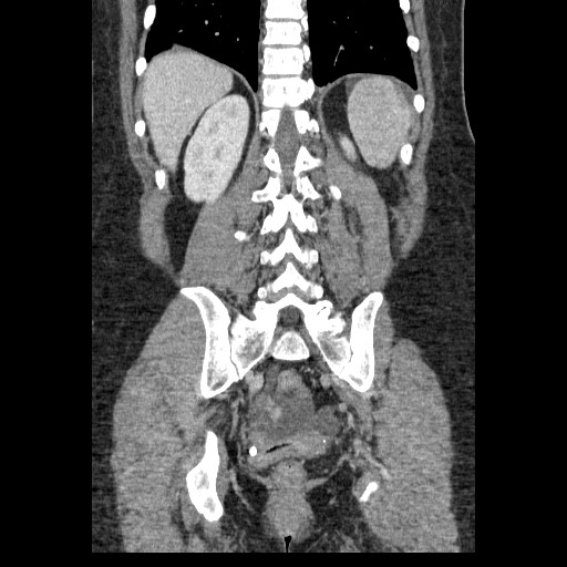 Closed loop small bowel obstruction (Radiopaedia 65403-74451 B 80).jpg
